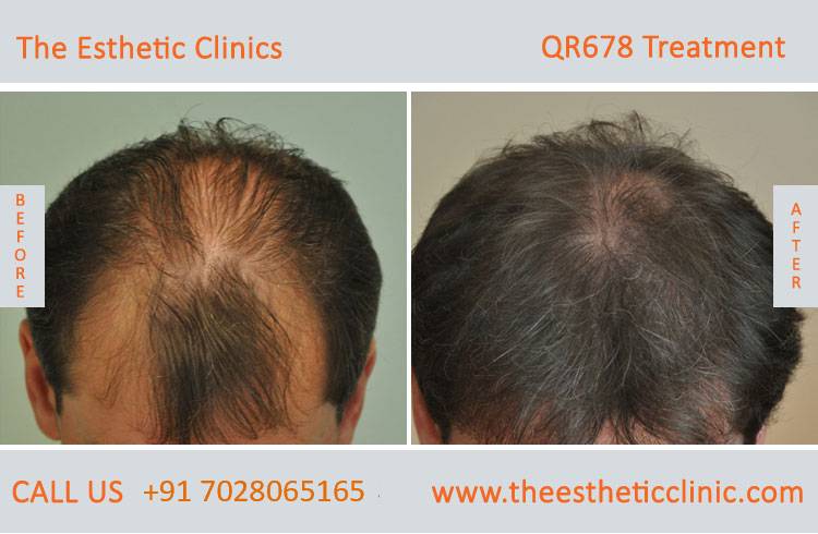 qr678 treatment, qr678 hair injection injection before after photos in mumbai india (3)